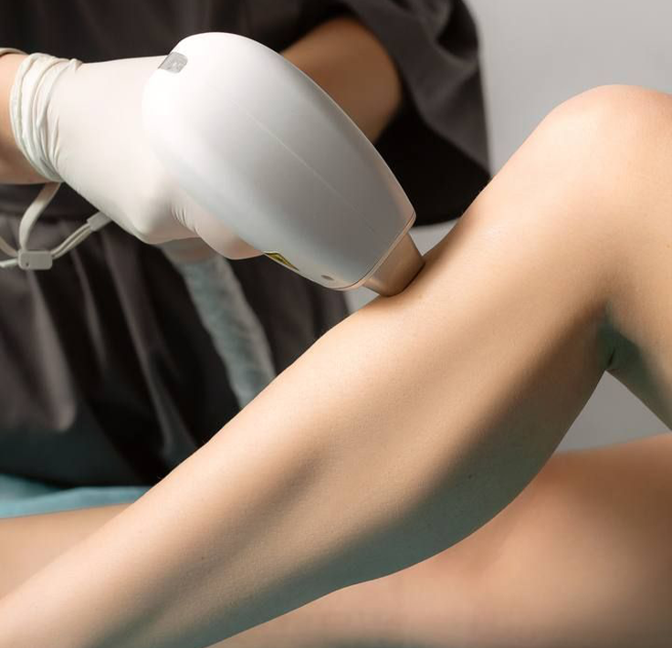 Лазерная эпиляция